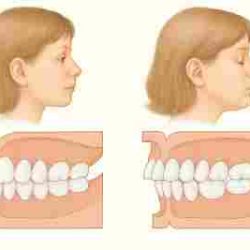 Туризм: советы|Как возраст пациента влияет на сроки исправления прикуса?