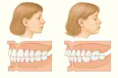 Туризм: советы | Как возраст пациента влияет на сроки исправления прикуса?